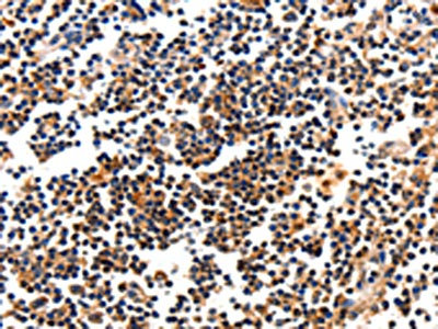 The image on the left is immunohistochemistry of paraffin-embedded Human tonsil tissue using CSB-PA128065(CAMK1 Antibody) at dilution 1/10, on the right is treated with fusion protein. (Original magnification: x200)