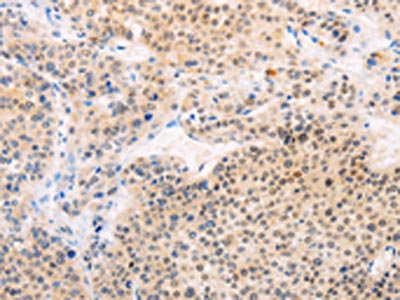 The image on the left is immunohistochemistry of paraffin-embedded Human liver cancer tissue using CSB-PA143673(MAP3K12 Antibody) at dilution 1/25, on the right is treated with fusion protein. (Original magnification: x200)