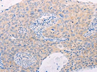 The image on the left is immunohistochemistry of paraffin-embedded Human cervical cancer tissue using CSB-PA143673(MAP3K12 Antibody) at dilution 1/25, on the right is treated with fusion protein. (Original magnification: x200)