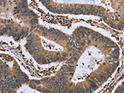 The image is immunohistochemistry of paraffin-embedded Human colon cancer tissue using CSB-PA212749(GADD45B Antibody) at dilution 1/30. (Original magnification: x200)