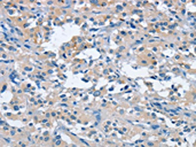 The image on the left is immunohistochemistry of paraffin-embedded Human thyroid cancer tissue using CSB-PA215086(FGF9 Antibody) at dilution 1/25, on the right is treated with fusion protein. (Original magnification: x200)