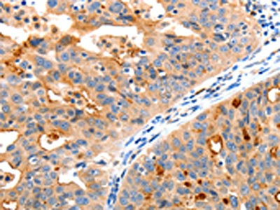 The image on the left is immunohistochemistry of paraffin-embedded Human ovarian cancer tissue using CSB-PA224661(MAP2K2 Antibody) at dilution 1/20, on the right is treated with synthetic peptide. (Original magnification: x200)