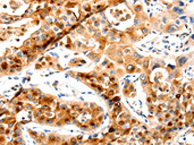 The image on the left is immunohistochemistry of paraffin-embedded Human lung cancer tissue using CSB-PA224661(MAP2K2 Antibody) at dilution 1/20, on the right is treated with synthetic peptide. (Original magnification: x200)