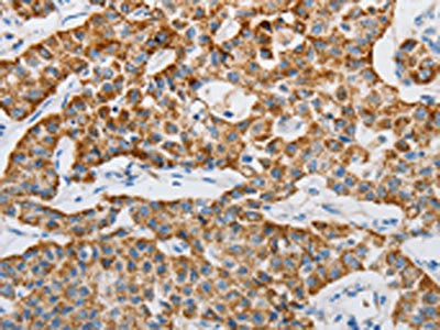 The image on the left is immunohistochemistry of paraffin-embedded Human lung cancer tissue using CSB-PA246788(MAP3K5 Antibody) at dilution 1/20, on the right is treated with synthetic peptide. (Original magnification: x200)