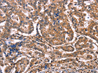 The image on the left is immunohistochemistry of paraffin-embedded Human breast cancer tissue using CSB-PA262509(MAP3K2 Antibody) at dilution 1/20, on the right is treated with synthetic peptide. (Original magnification: x200)