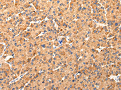 The image on the left is immunohistochemistry of paraffin-embedded Human liver cancer tissue using CSB-PA276755(AQP7 Antibody) at dilution 1/40, on the right is treated with synthetic peptide. (Original magnification: x200)