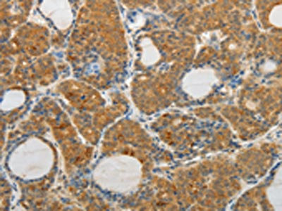 The image on the left is immunohistochemistry of paraffin-embedded Human thyroid cancer tissue using CSB-PA286198(MAP4K5 Antibody) at dilution 1/10, on the right is treated with fusion protein. (Original magnification: x200)