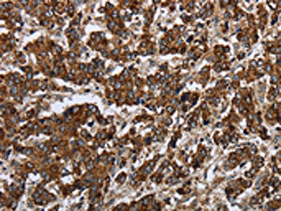 The image on the left is immunohistochemistry of paraffin-embedded Human liver cancer tissue using CSB-PA296760(PPP1R13L Antibody) at dilution 1/30, on the right is treated with synthetic peptide. (Original magnification: x200)