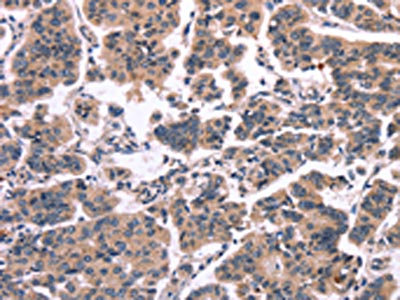 The image on the left is immunohistochemistry of paraffin-embedded Human breast cancer tissue using CSB-PA299002(MAPK13 Antibody) at dilution 1/15, on the right is treated with synthetic peptide. (Original magnification: x200)