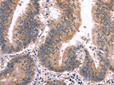 The image on the left is immunohistochemistry of paraffin-embedded Human colon cancer tissue using CSB-PA299002(MAPK13 Antibody) at dilution 1/15, on the right is treated with synthetic peptide. (Original magnification: x200)