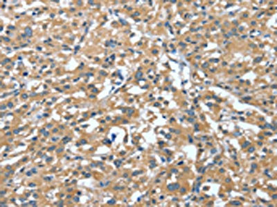 The image on the left is immunohistochemistry of paraffin-embedded Human thyroid cancer tissue using CSB-PA447859(DTX1 Antibody) at dilution 1/30, on the right is treated with synthetic peptide. (Original magnification: x200)