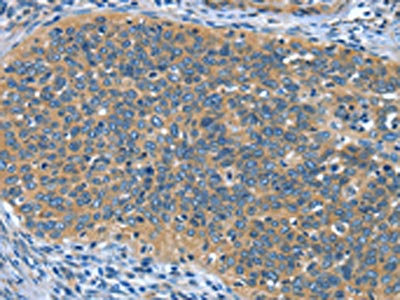 The image on the left is immunohistochemistry of paraffin-embedded Human cervical cancer tissue using CSB-PA447859(DTX1 Antibody) at dilution 1/30, on the right is treated with synthetic peptide. (Original magnification: x200)