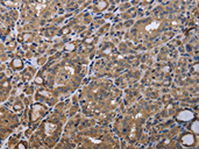 The image is immunohistochemistry of paraffin-embedded Human thyroid cancer tissue using CSB-PA526376(GADD45B Antibody) at dilution 1/40. (Original magnification: x200)