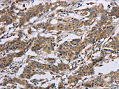 The image on the left is immunohistochemistry of paraffin-embedded Human gastic cancer tissue using CSB-PA557600(SYN2 Antibody) at dilution 1/40, on the right is treated with synthetic peptide. (Original magnification: x200)