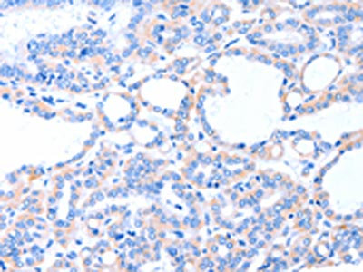 The image on the left is immunohistochemistry of paraffin-embedded Human thyroid cancer tissue using CSB-PA598870(ACAD8 Antibody) at dilution 1/20, on the right is treated with fusion protein. (Original magnification: x200)