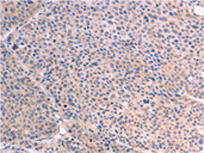 The image on the left is immunohistochemistry of paraffin-embedded Human liver cancer tissue using CSB-PA617153(RELA Antibody) at dilution 1/25, on the right is treated with fusion protein. (Original magnification: x200)