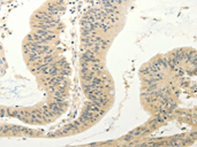 The image on the left is immunohistochemistry of paraffin-embedded Human colon cancer tissue using CSB-PA617545(FZD8 Antibody) at dilution 1/30, on the right is treated with synthetic peptide. (Original magnification: x200)