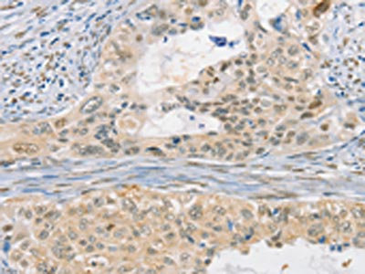 The image on the left is immunohistochemistry of paraffin-embedded Human cervical cancer tissue using CSB-PA617763(CDC27 Antibody) at dilution 1/50, on the right is treated with fusion protein. (Original magnification: x200)