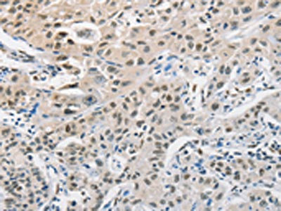 The image on the left is immunohistochemistry of paraffin-embedded Human lung cancer tissue using CSB-PA617763(CDC27 Antibody) at dilution 1/50, on the right is treated with fusion protein. (Original magnification: x200)