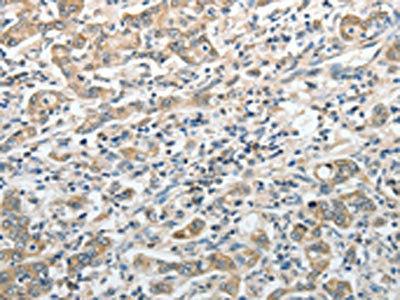 The image on the left is immunohistochemistry of paraffin-embedded Human gastric cancer tissue using CSB-PA686209(PRMT2 Antibody) at dilution 1/20, on the right is treated with fusion protein. (Original magnification: x200)