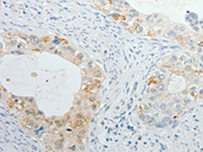 The image on the left is immunohistochemistry of paraffin-embedded Human cervical cancer tissue using CSB-PA827458(TIMP1 Antibody) at dilution 1/15, on the right is treated with fusion protein. (Original magnification: X200)