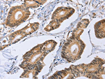 The image on the left is immunohistochemistry of paraffin-embedded Human colon cancer tissue using CSB-PA925811(MAP2K1 Antibody) at dilution 1/20, on the right is treated with fusion protein. (Original magnification: x200)