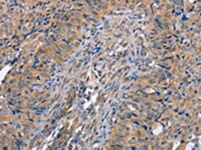 The image on the left is immunohistochemistry of paraffin-embedded Human cervical cancer tissue using CSB-PA925811(MAP2K1 Antibody) at dilution 1/20, on the right is treated with fusion protein. (Original magnification: x200)