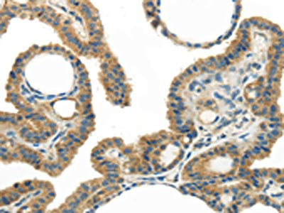 The image on the left is immunohistochemistry of paraffin-embedded Human thyroid cancer tissue using CSB-PA938031(WISP1 Antibody) at dilution 1/25, on the right is treated with synthetic peptide. (Original magnification: x200)