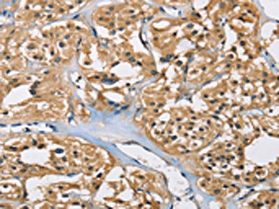 The image on the left is immunohistochemistry of paraffin-embedded Human thyroid cancer tissue using CSB-PA943107(PPP3CA Antibody) at dilution 1/40, on the right is treated with fusion protein. (Original magnification: x200)