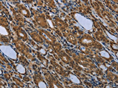 The image is immunohistochemistry of paraffin-embedded Human thyroid cancer tissue using CSB-PA948107(SMAD4 Antibody) at dilution 1/40. (Original magnification: x200)