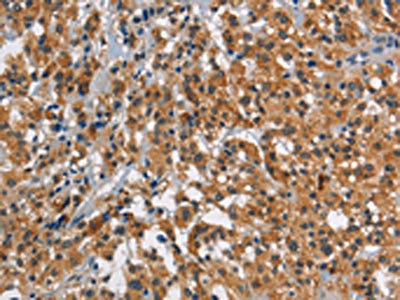 The image on the left is immunohistochemistry of paraffin-embedded Human thyroid cancer tissue using CSB-PA948873(SMAD9 Antibody) at dilution 1/30, on the right is treated with synthetic peptide. (Original magnification: x200)