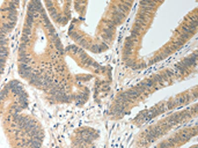 The image on the left is immunohistochemistry of paraffin-embedded Human colon cancer tissue using CSB-PA949361(MAP4K5 Antibody) at dilution 1/20, on the right is treated with fusion protein. (Original magnification: x200)