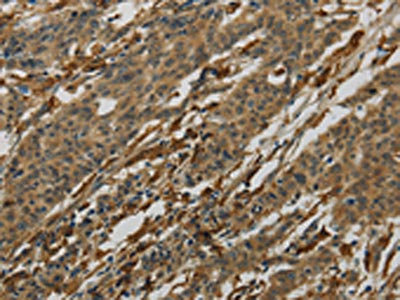 The image on the left is immunohistochemistry of paraffin-embedded Human gastric cancer tissue using CSB-PA970771(AIF1 Antibody) at dilution 1/50, on the right is treated with fusion protein. (Original magnification: x200)