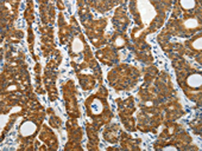 The image on the left is immunohistochemistry of paraffin-embedded Human thyroid cancer tissue using CSB-PA993400(PRDX5 Antibody) at dilution 1/40, on the right is treated with fusion protein. (Original magnification: x200)